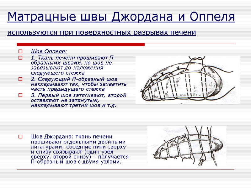 Матрацные швы Джордана и Оппеля  используются при поверхностных разрывах печени  Шов Оппеля: